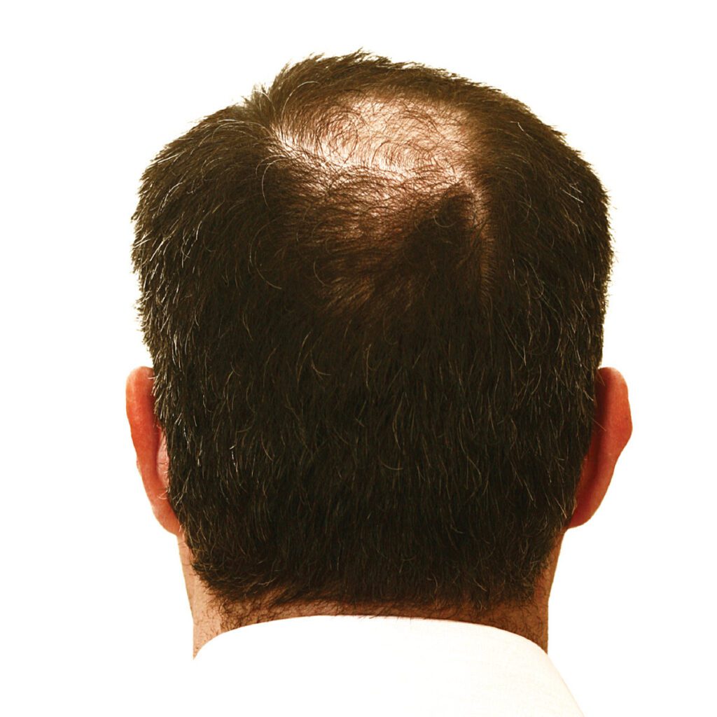 back of head of balding man