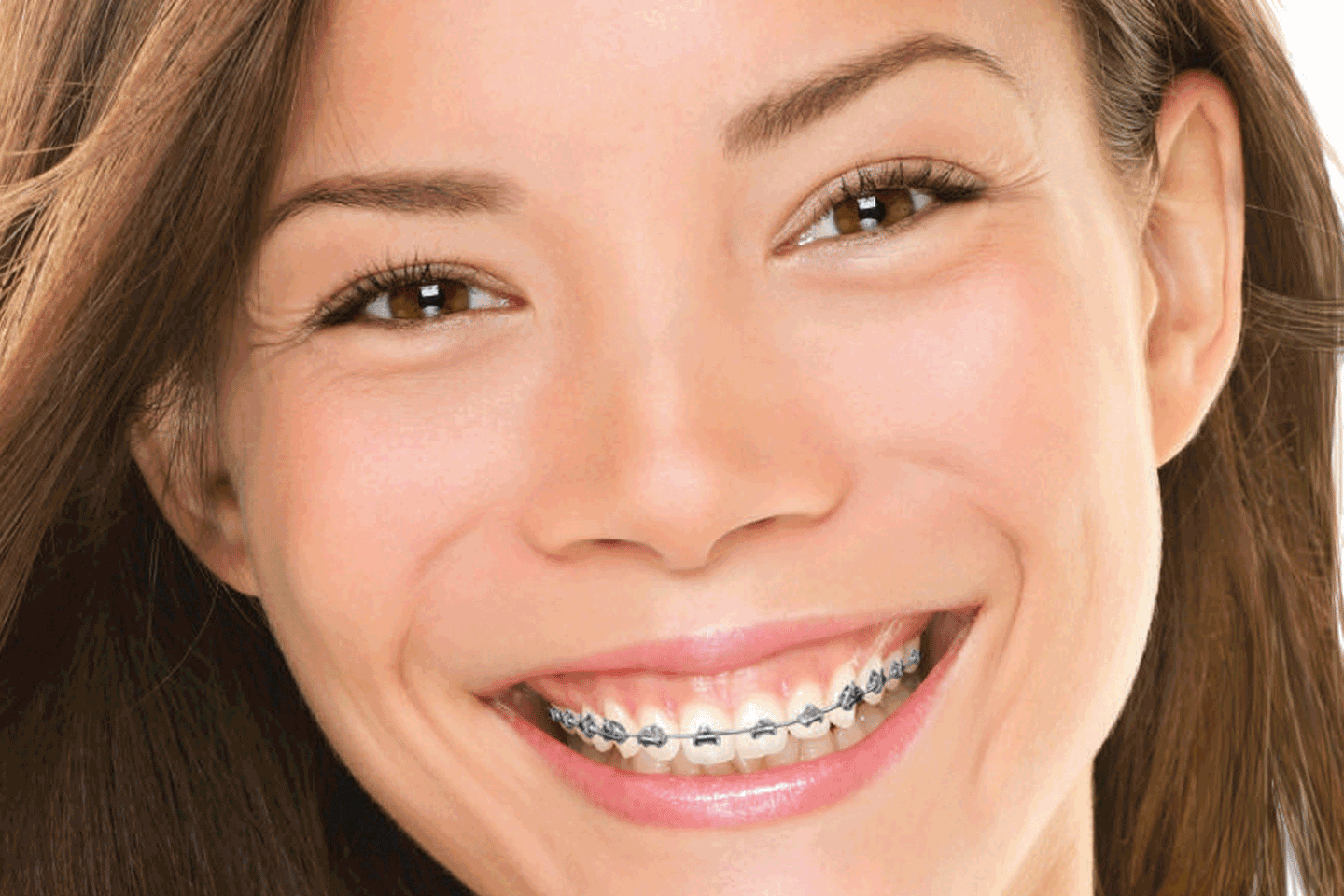 smiling girl with FASTBRACES® in chattanooga