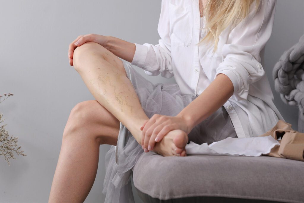 woman with spider veins on her leg