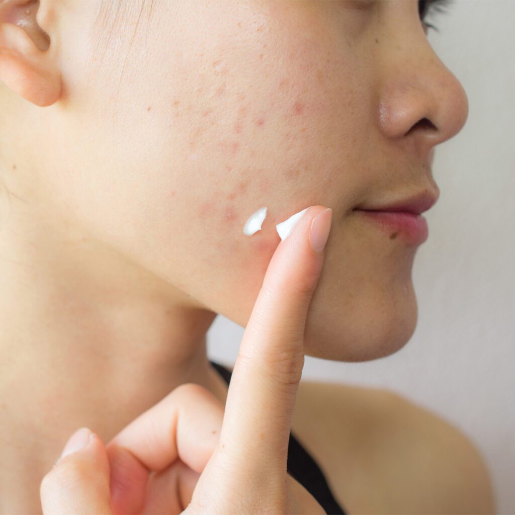woman applying acne cream to her pimples