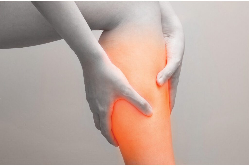 woman holding her calf where she had varicose veins